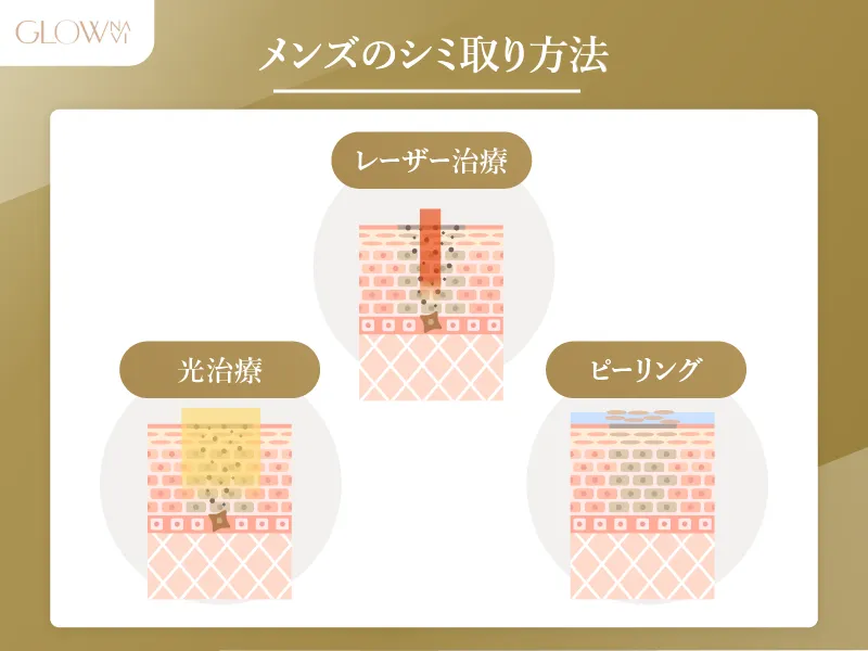 メンズ　シミ取り 方法